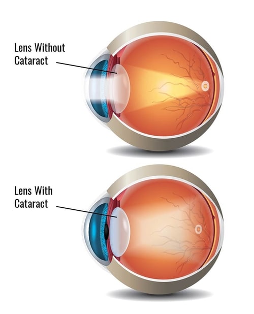 Frequently Asked Questions On Cataract Surgery