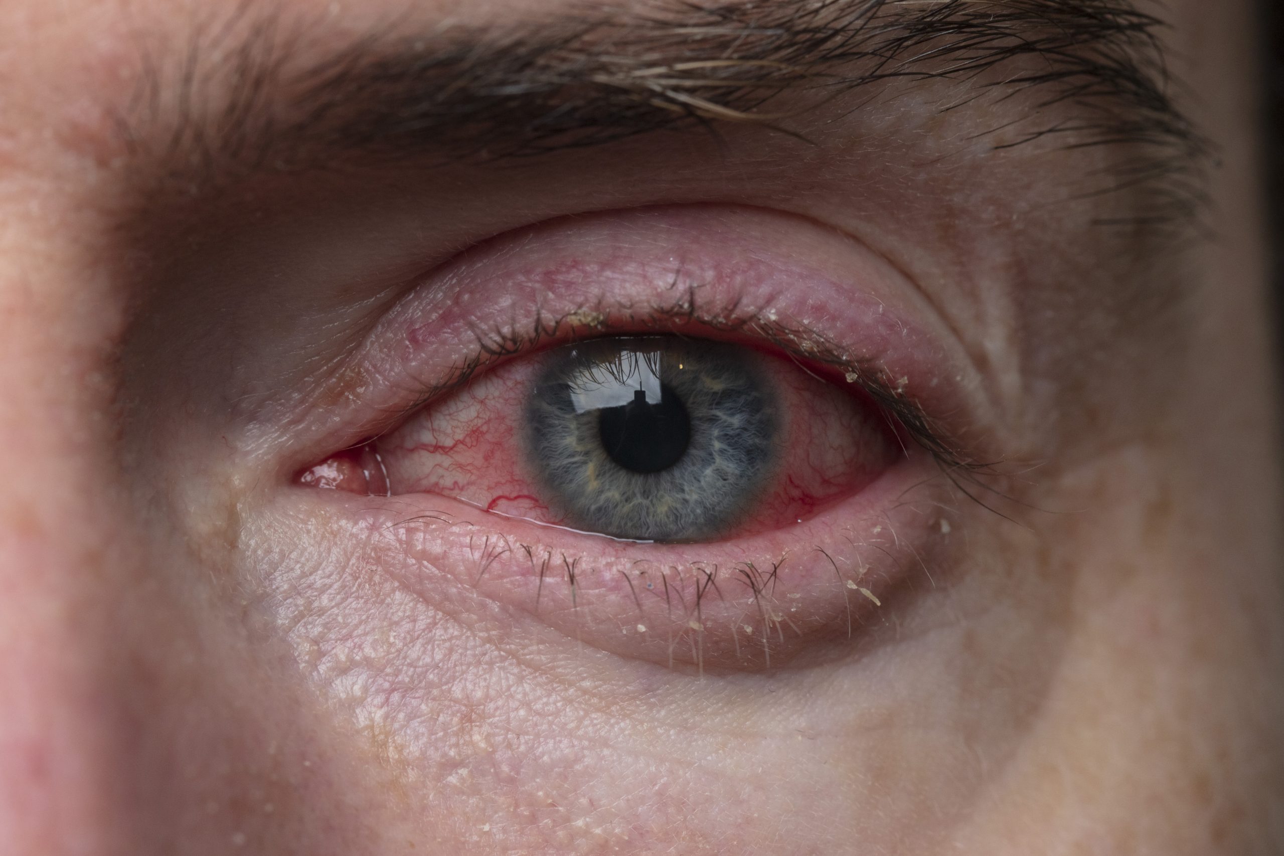 9 Common eye problems and its prevention