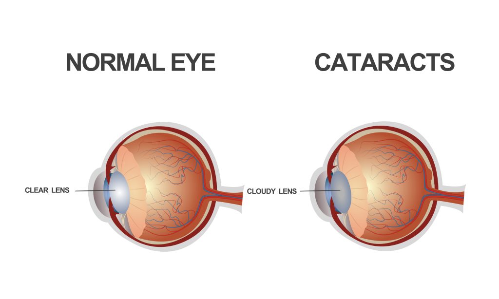 The structure of the eye. Cataract. Vector illustration