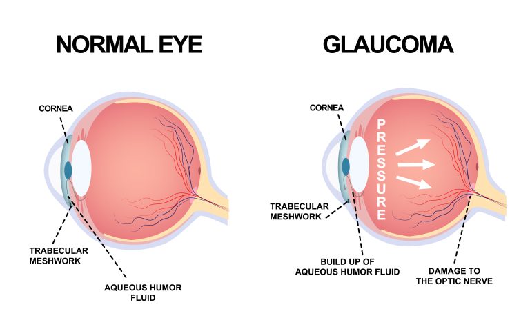 glaucoma and genetics