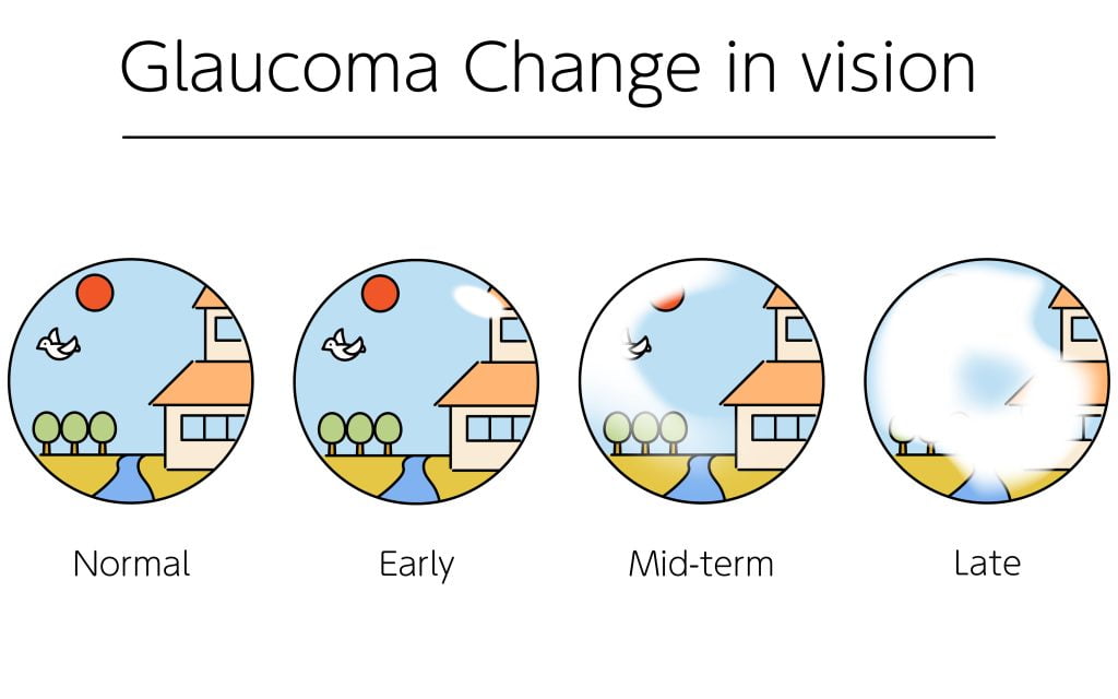 Illustration of glaucoma, changes in visual field as glaucoma pr