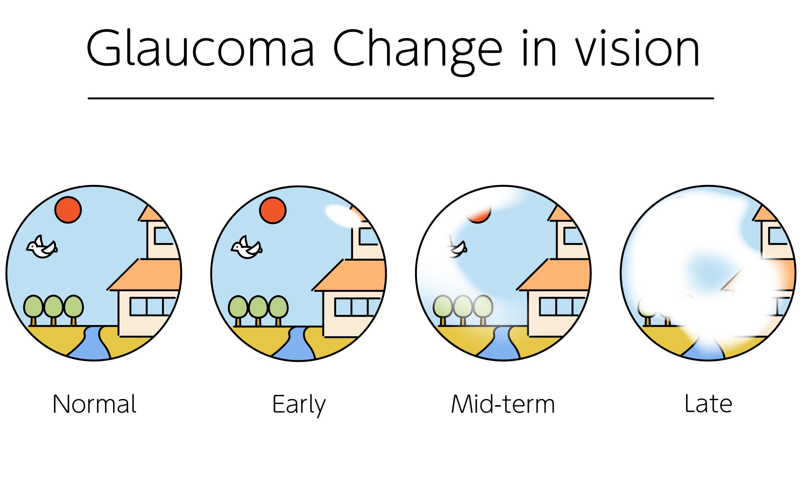 glaucoma and genetics