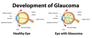 Best Glaucoma Surgery in Badlapur