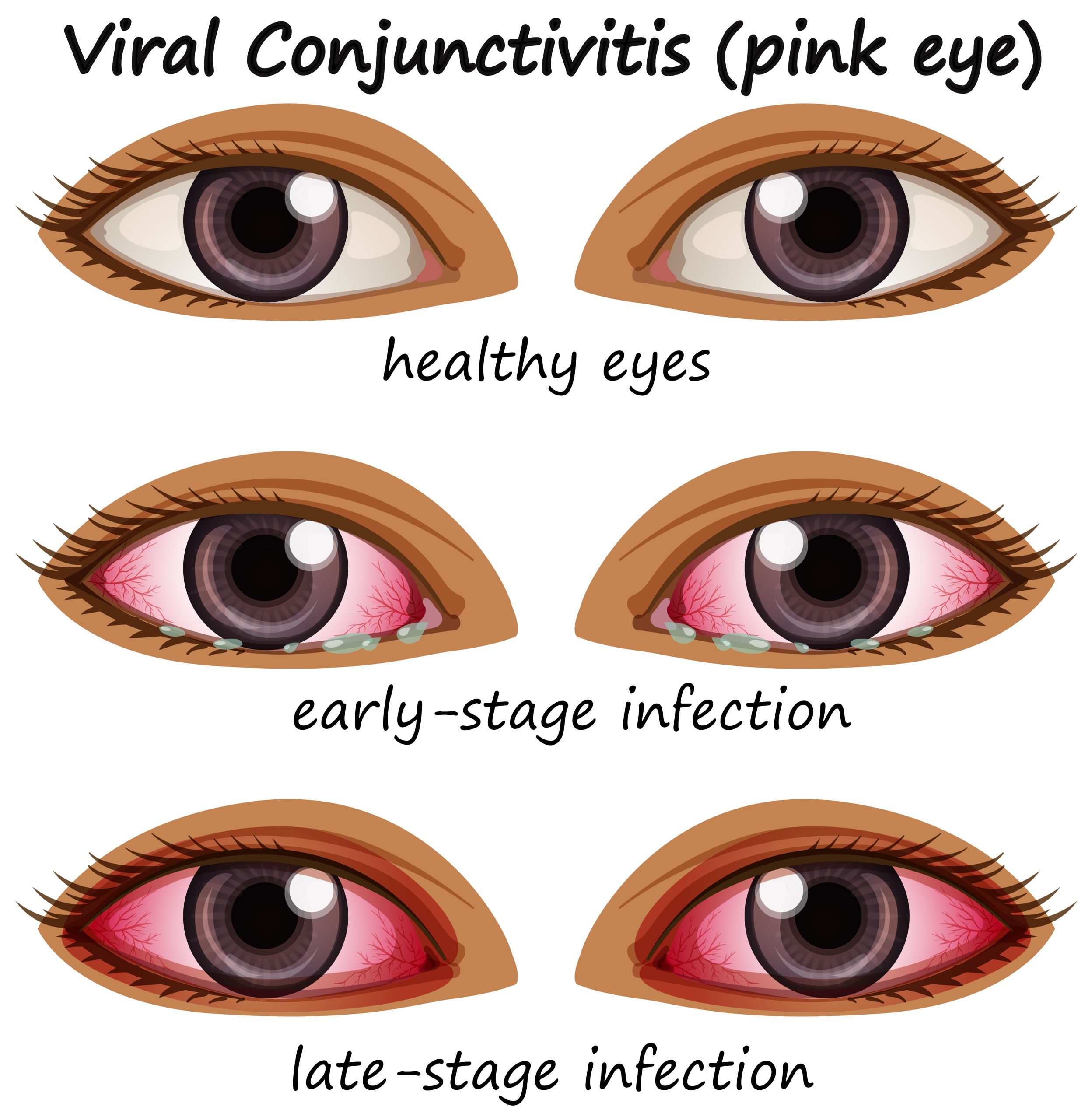 eye infection during pregnancy