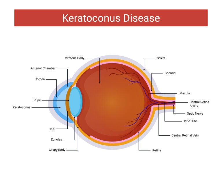 keratoconusdiseases_06