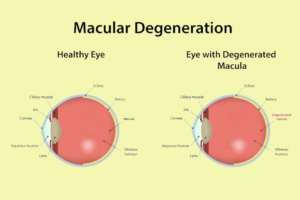 Macular Degeneration Surgery in Kalyan