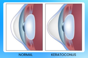 Best Keratoconus Treatment in Thane