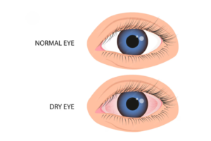 Eye Doctor For Dry Eyes in Kalyan