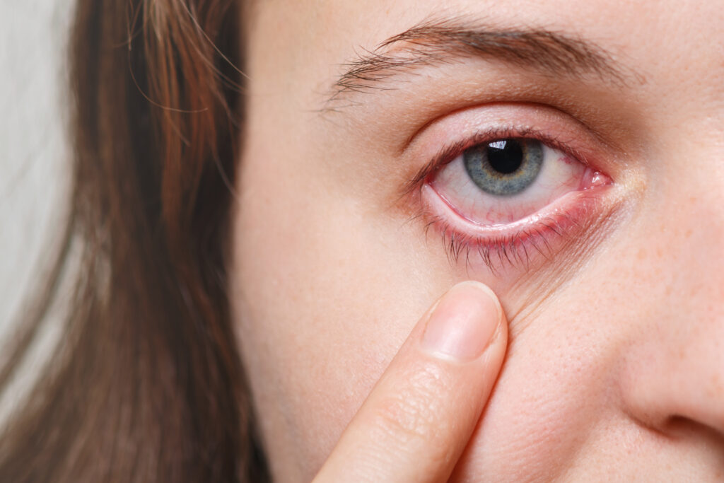 Relief Starts with the Best Doctor for Dry Eyes in Kalyan
