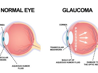 glaucoma and genetics