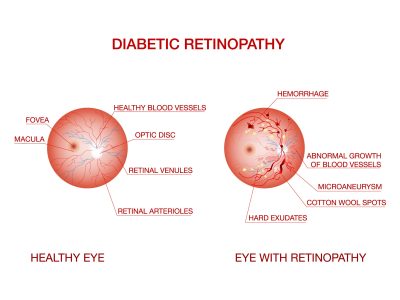 diabetic_retinopathy_detailed_anatomy_2 diabetic_retinopathy_detailed_anatomy_2